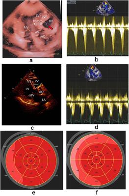 Sigmoid ventricular septum treated with endocardial ablation to improve left ventricular outflow: cases report